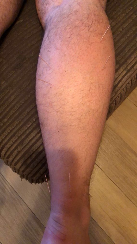 Actupuncture Photo